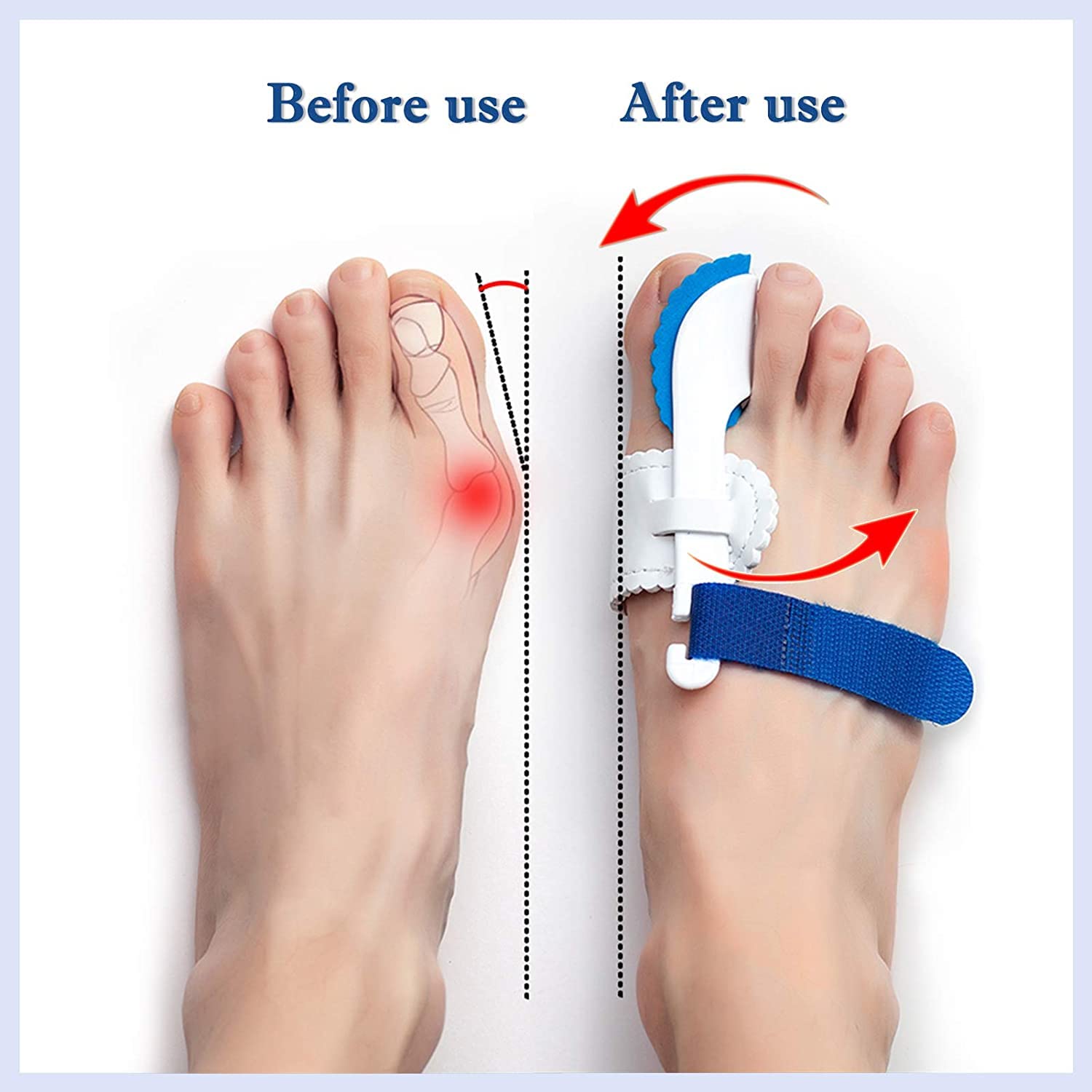 Correcteur d'Orteil Hallux Valgus